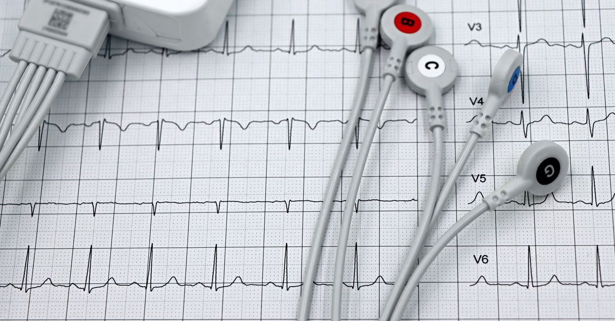 Electrocardiogram printout with electrode leads, the first test used to investigate heart palpitations